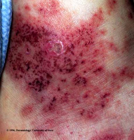 Vasculitis- henoch-Schonlein Purpura | Department of Dermatology