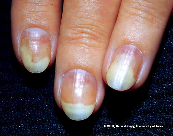 Fingernail Fungus Images Treatment Toenail Infection Fungal Toenails ...