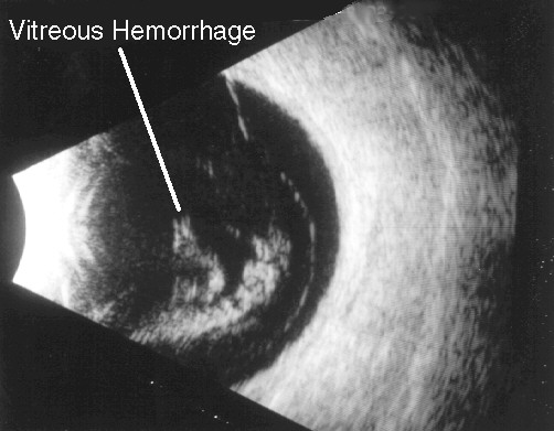 Ultrasound, vitreous hemorrhage