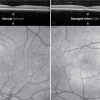 OCT (top) and infrared (bottom) images show laser maculopathy, which can look similar to solar retinopathy and has the same pathophysiology. 