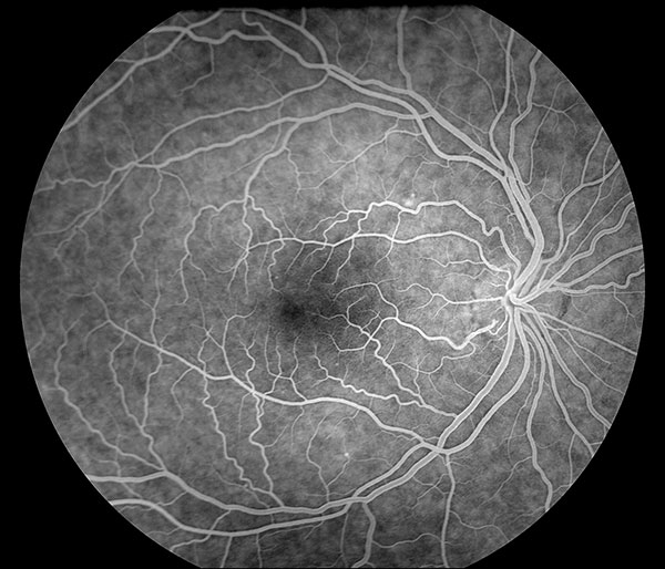 Normal Fluorescein Angiogram. Complete fill of retinal arteries and veins