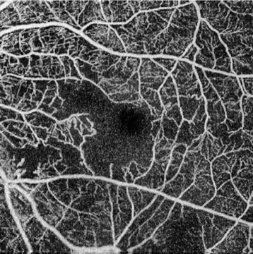 OCT-A capillary loss in macula from radiation retinopathy