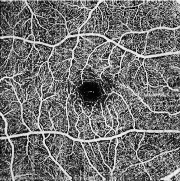 OCT-A normal capillary density in macula