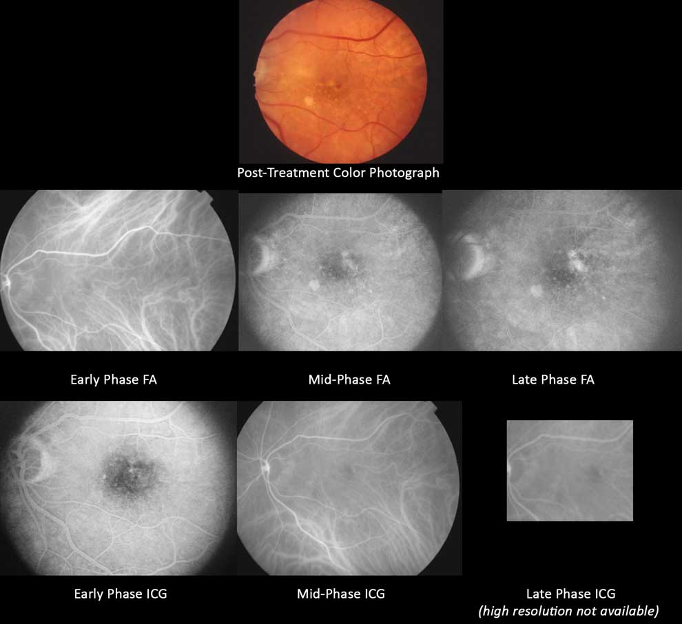 Post treatment color fundus, F A and I C G