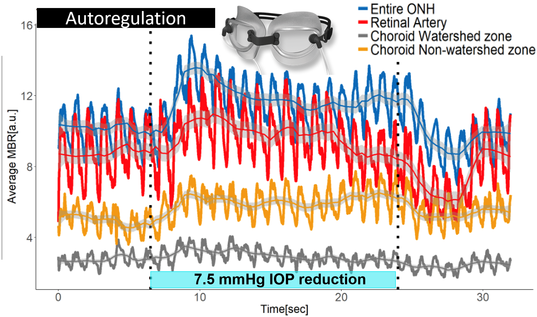 Vacuum Goggle Reduction of IOP