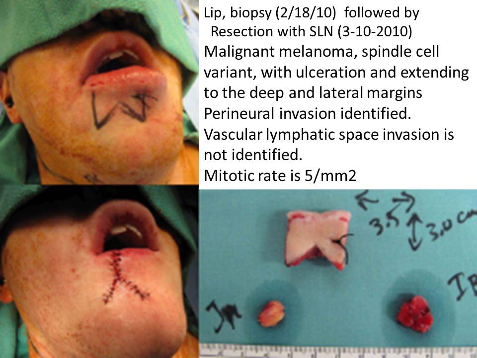 Lip Melanoma Resection With W Plasty And Sentinel Node Biopsy Case