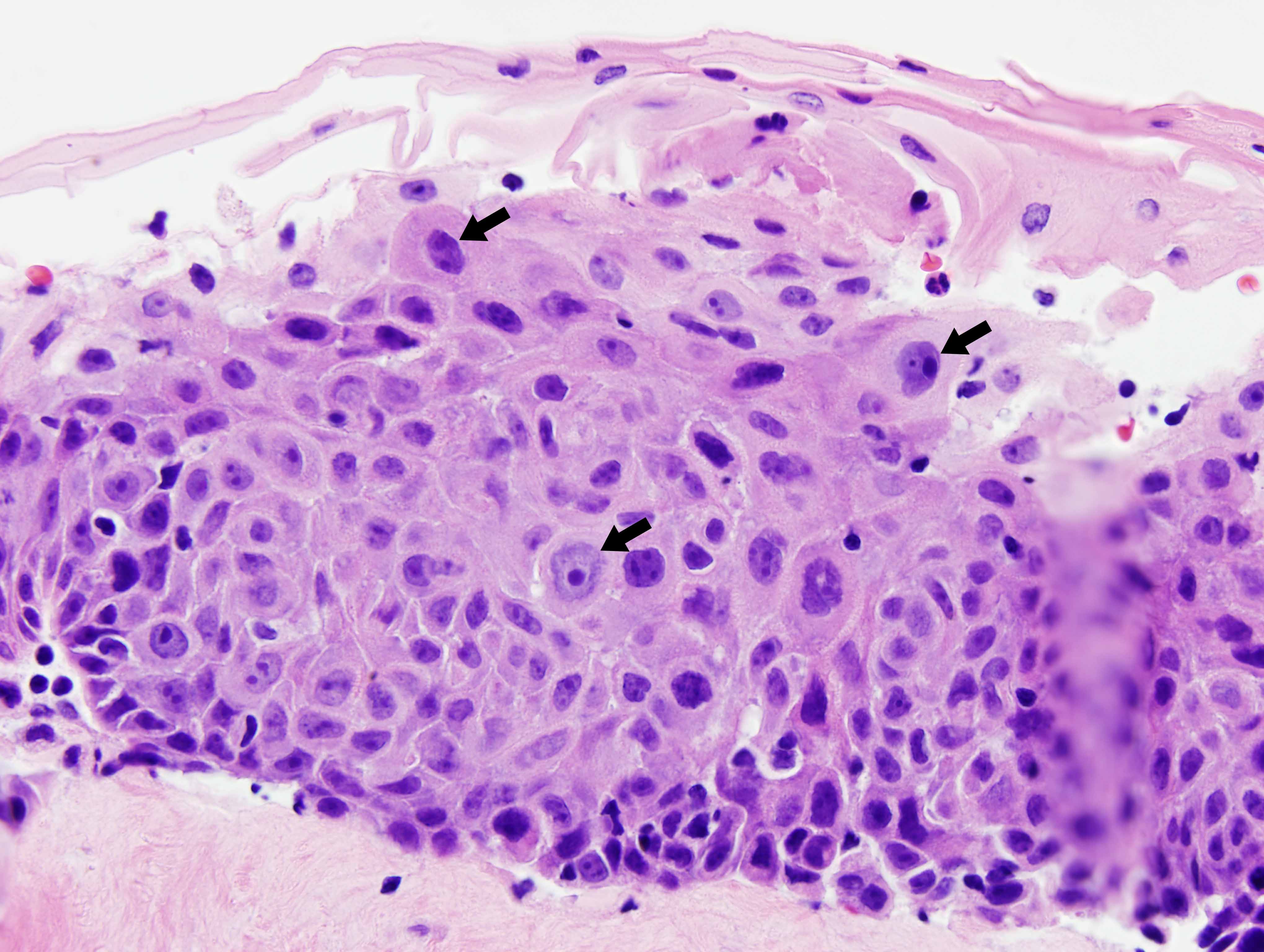 Laryngeal papilloma with dysplasia