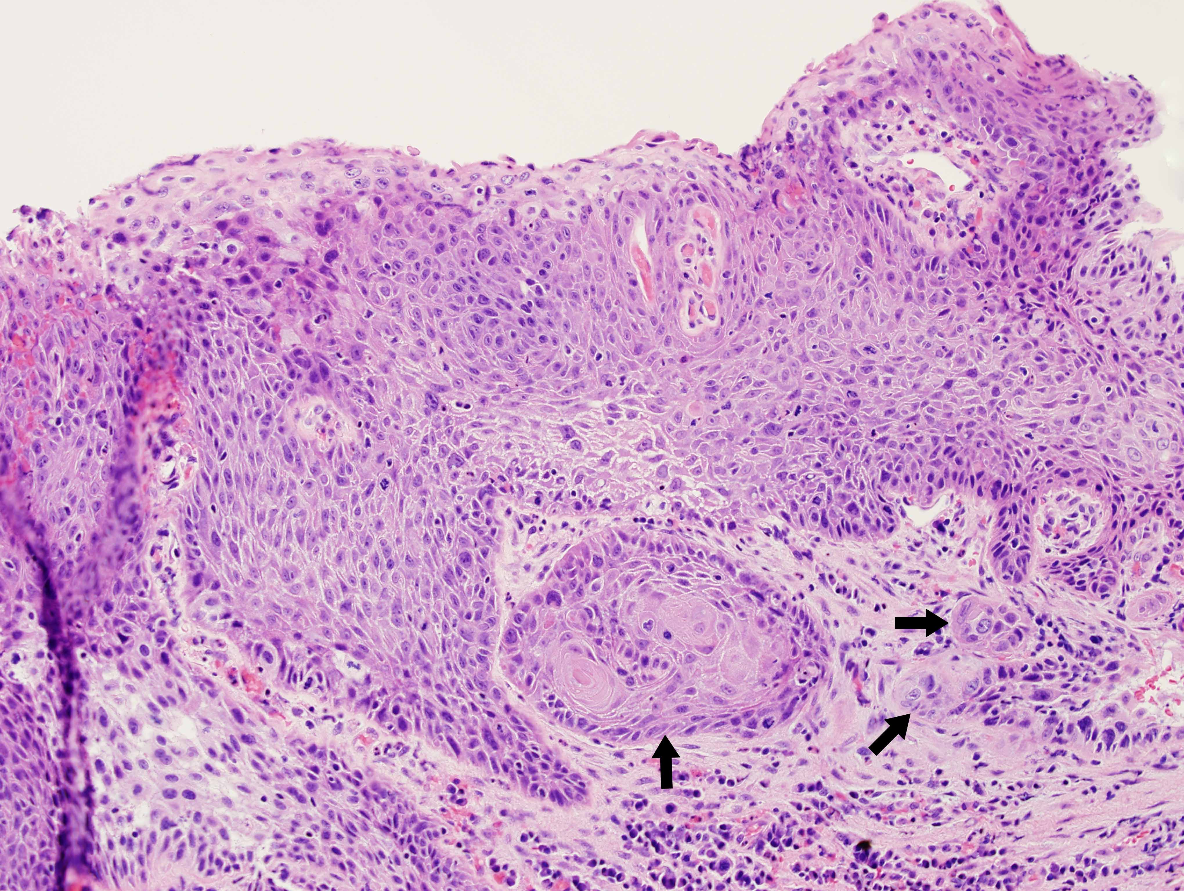 Invasive Squamous Cell Carcinoma Causing Laryngeal Leukoplakia Iowa
