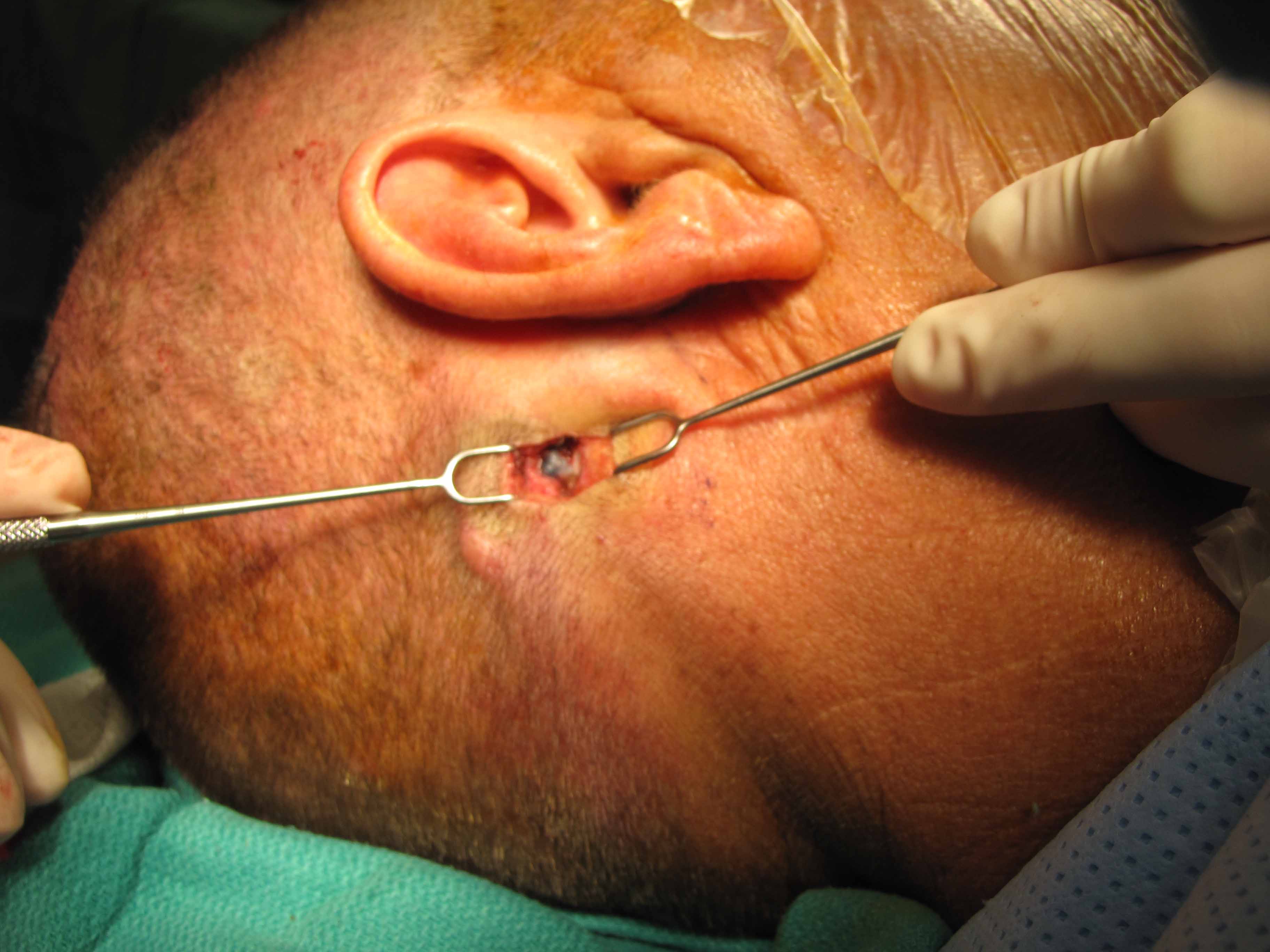 lymph nodes behind ear