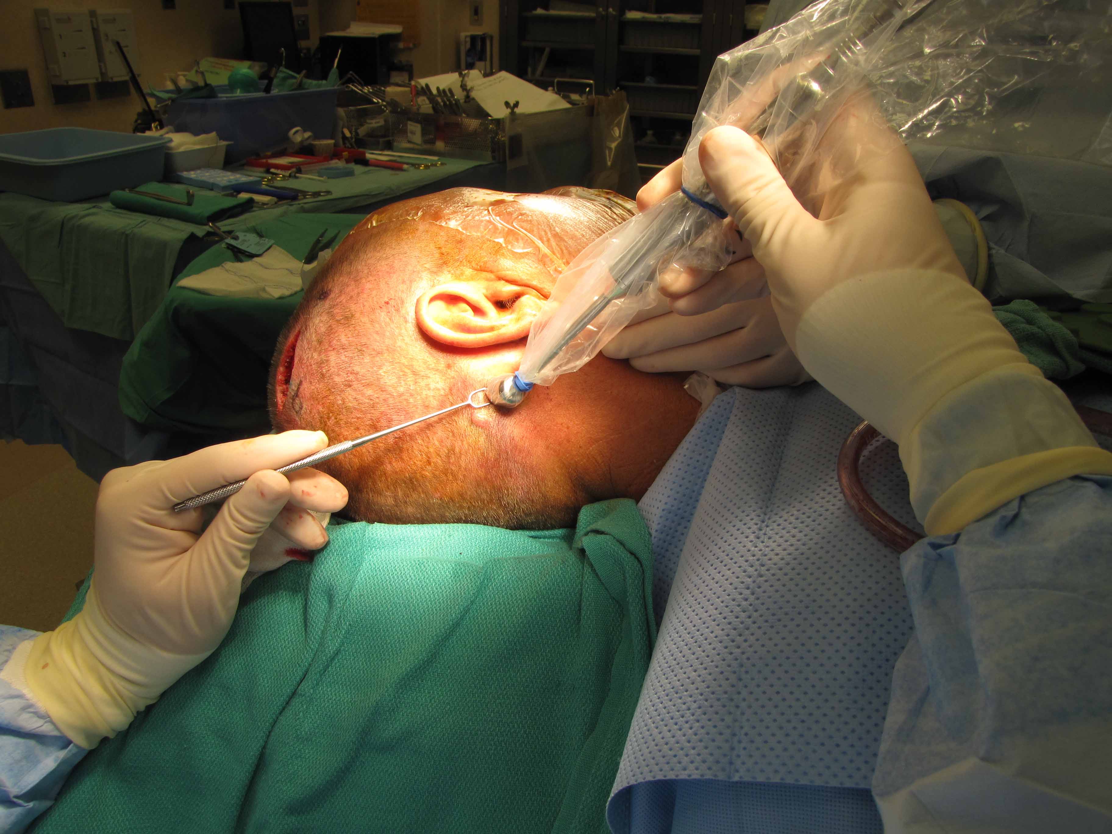 Case Example Sentinel Lymph Node Biopsy | Iowa Head and Neck Protocols