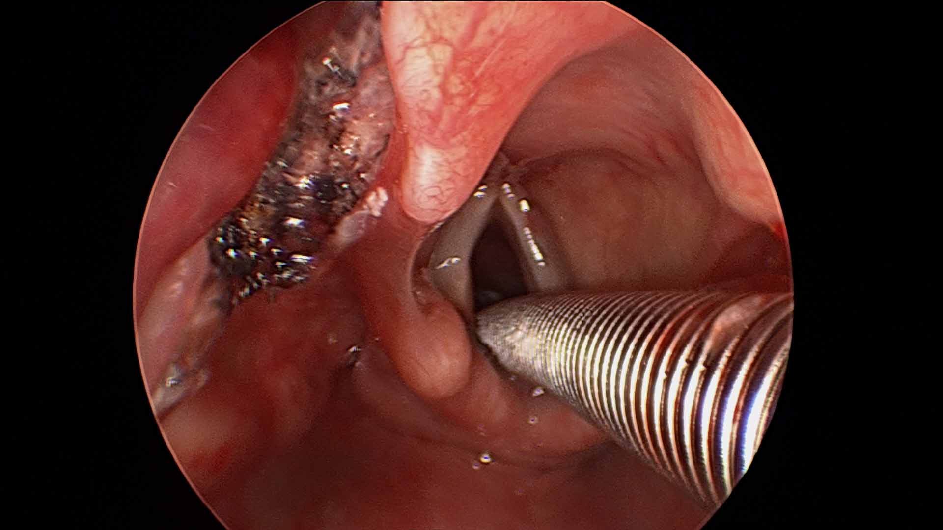 Vallecular Cyst Unusual Cause Of Lump In Throat Sensation Globus Iowa Head And Neck Protocols