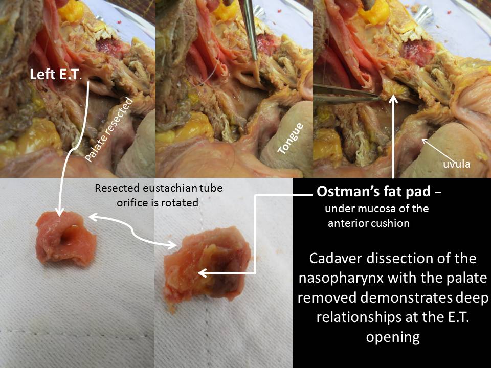 Patulous Eustachian Tube Management of the Symptom of Autophony