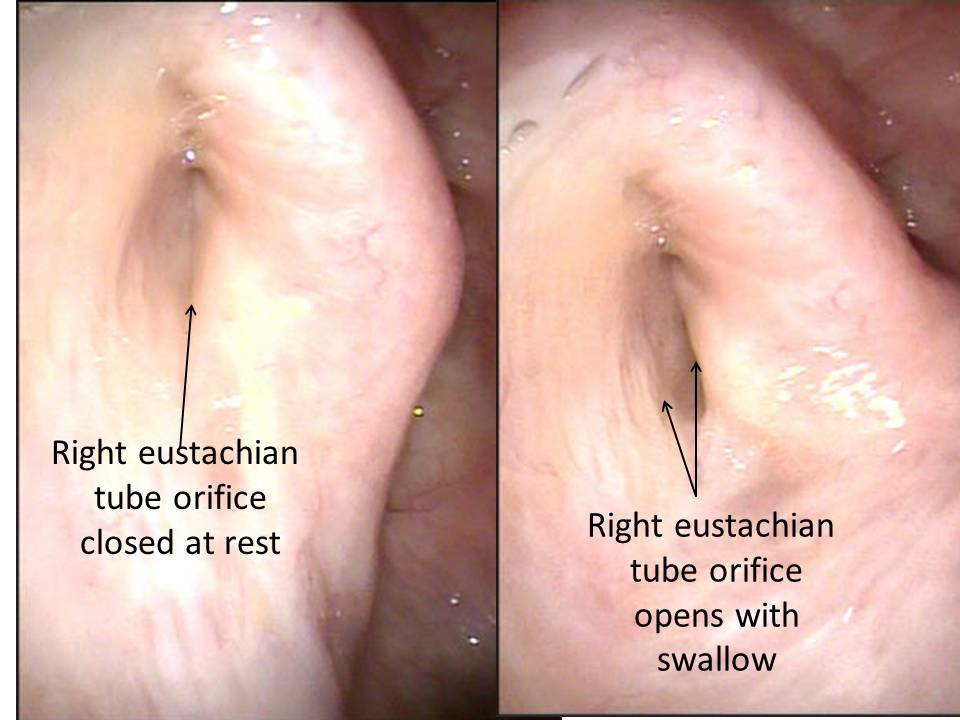 Patulous Eustachian Tube Management of the Symptom of Autophony