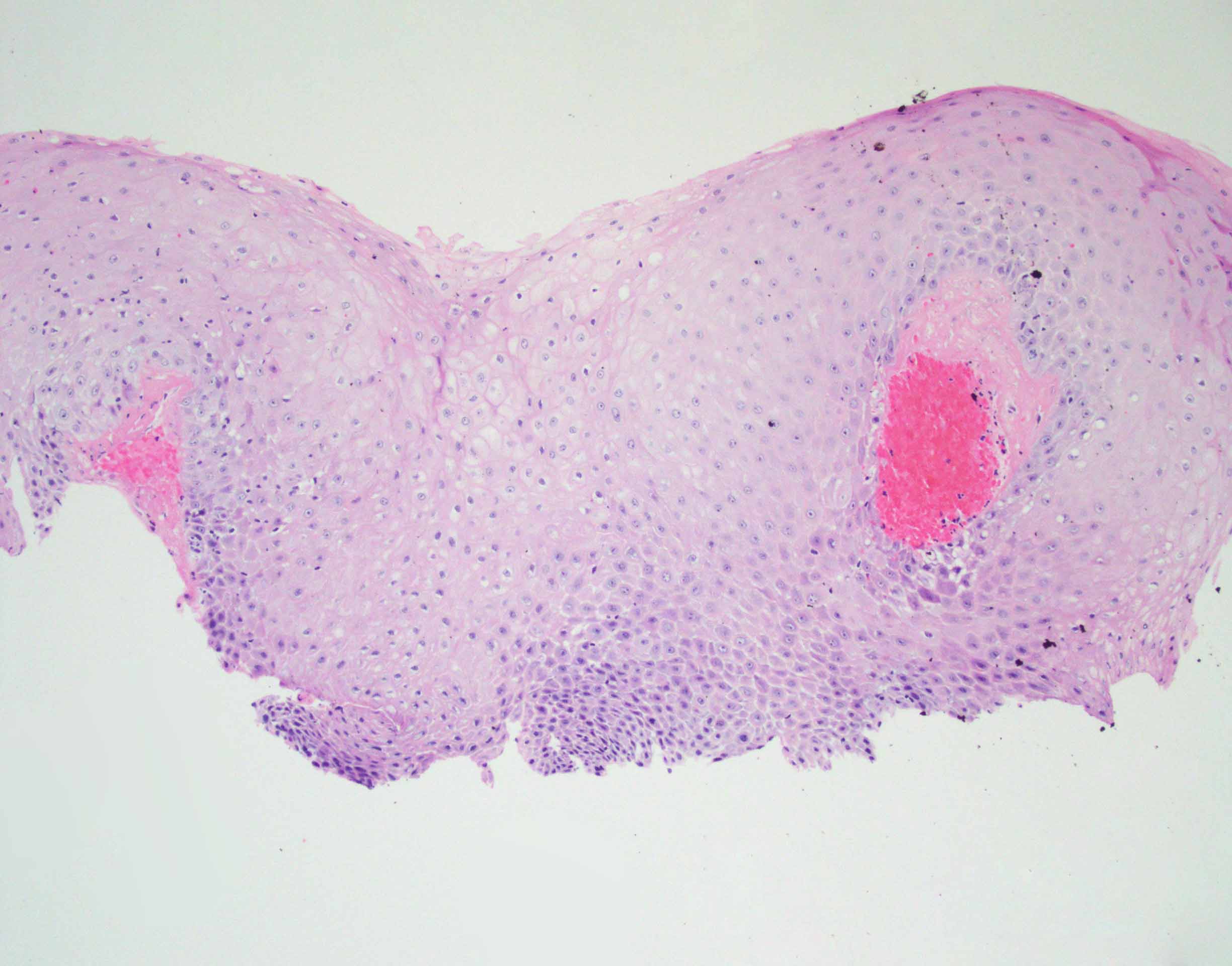 Laryngeal Leukoplakia Progression To Invasive Squamous Cell Carcinoma