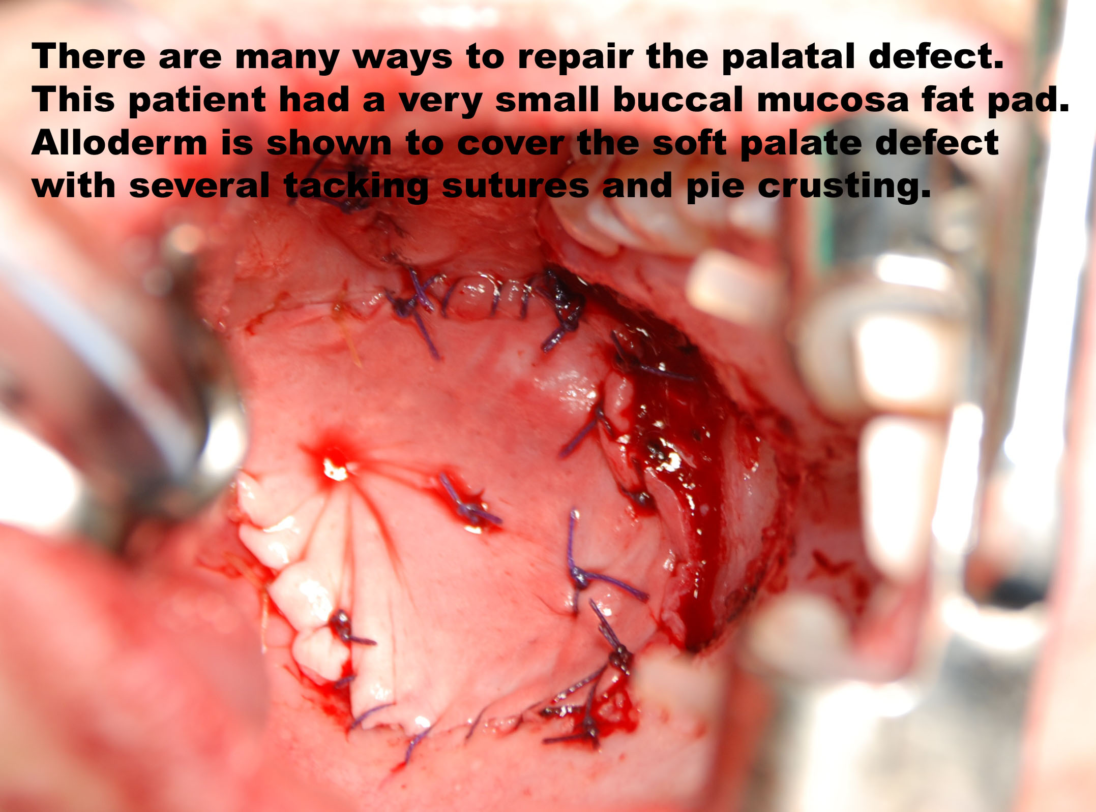 Pediatric Tracheotomy | Iowa Head and Neck Protocols