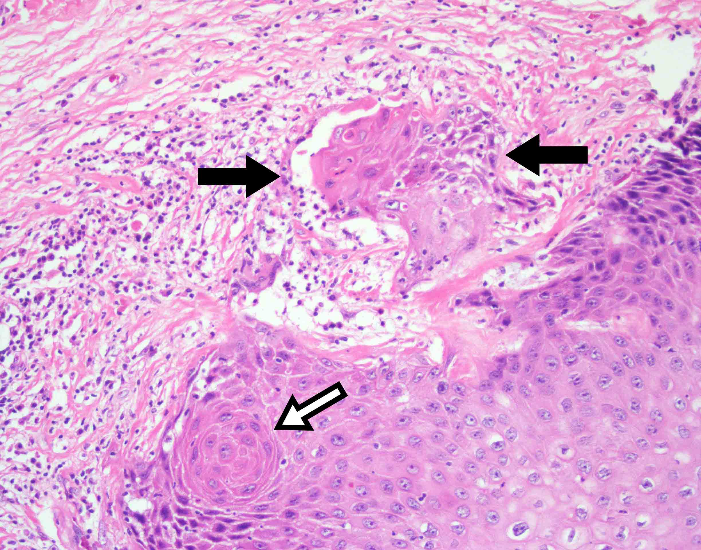 Laryngeal Leukoplakia Progression To Invasive Squamous Cell Carcinoma