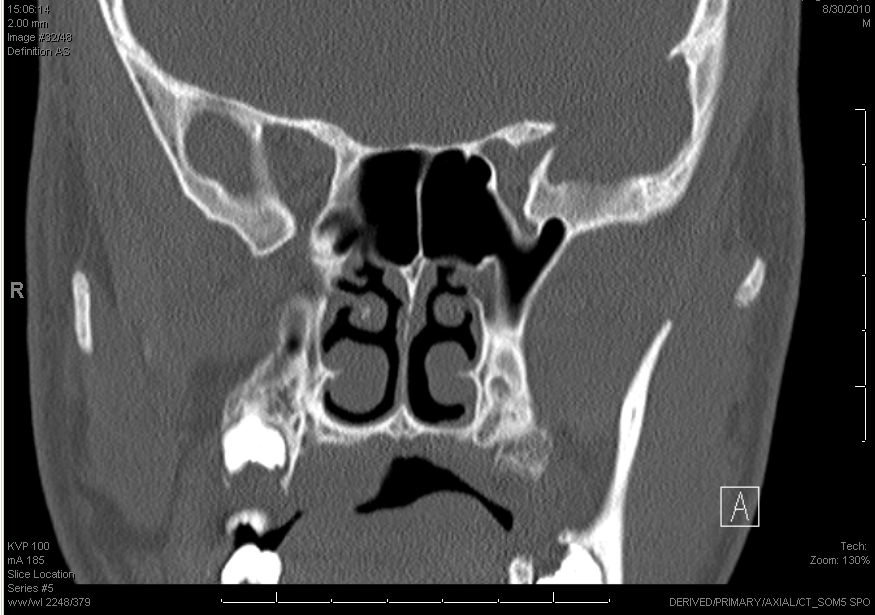 Pediatric Palatal Mass - Pleomorphic Adenoma | Iowa Head and Neck Protocols