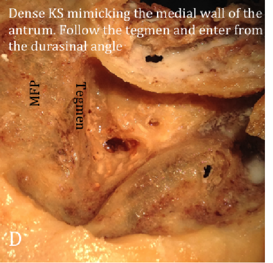 Temporal Bone Anatomy (Cadaveric Dissection) | Iowa Head and Neck Protocols