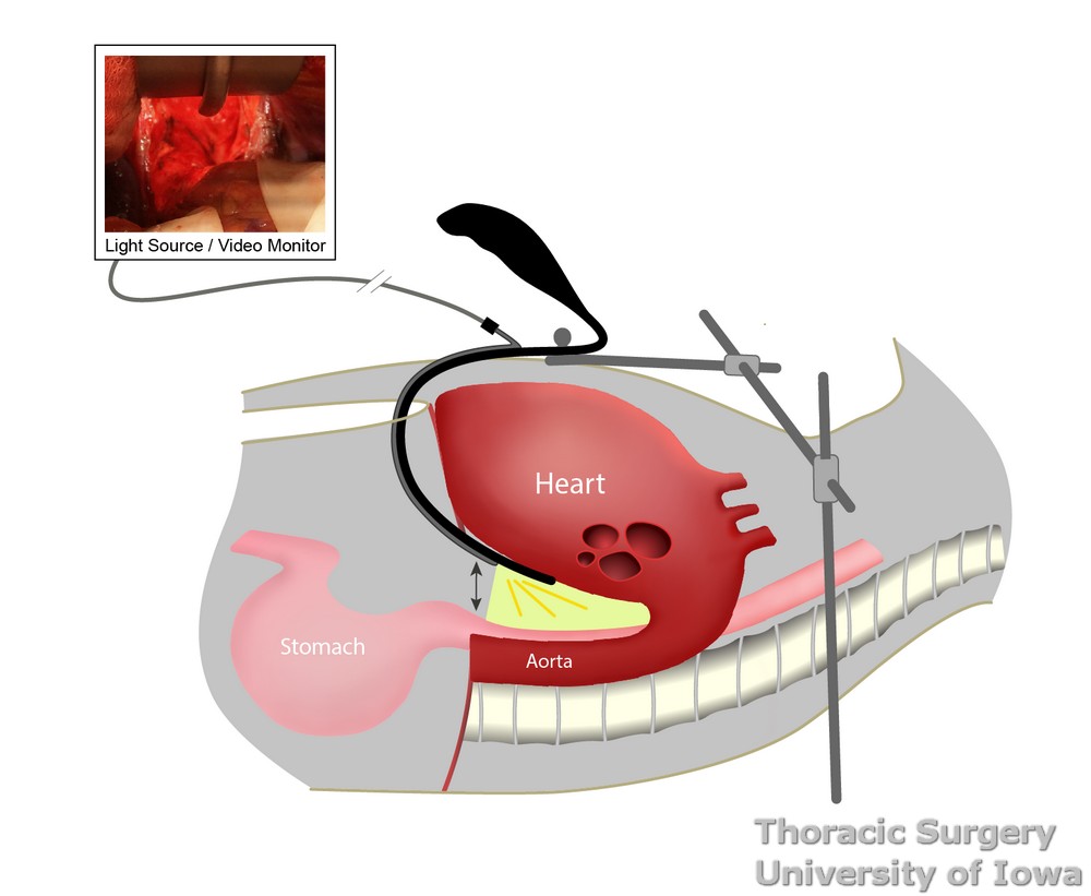 Arshava retractor_ design of a video transhiatal retractor to facilitate mediastinal dissection during transhiatal esophagectomy