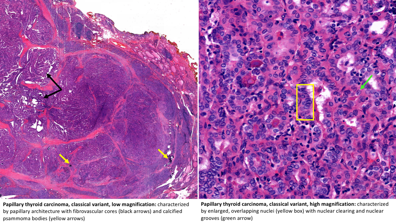 Variants of Papillary Thyroid Carcinoma (Microcarcinoma