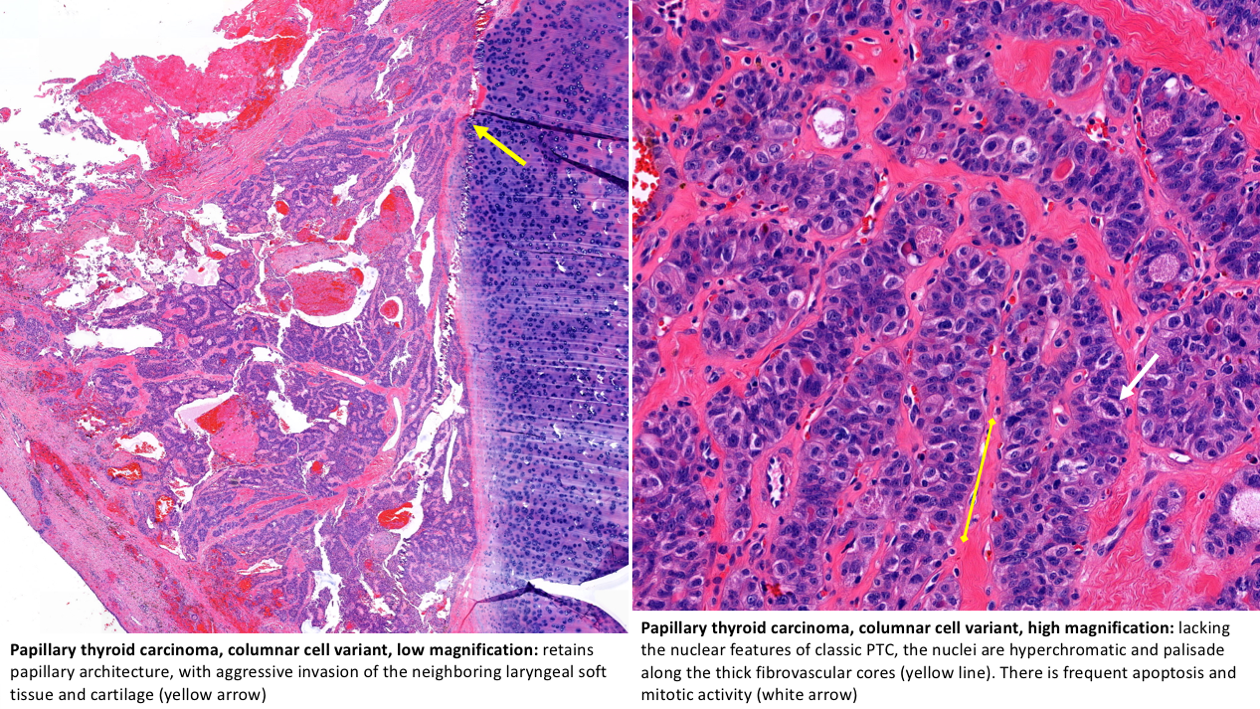 papillary carcinoma