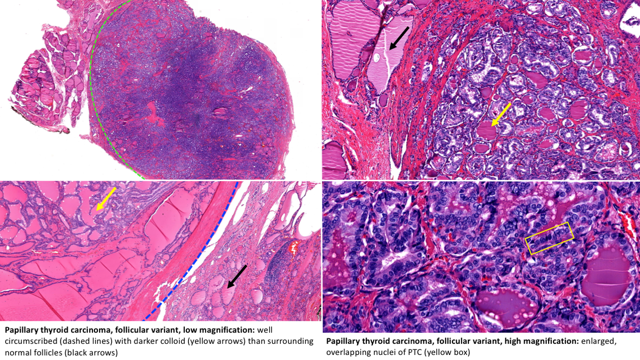 Variants of Papillary Thyroid Carcinoma (Microcarcinoma ...
