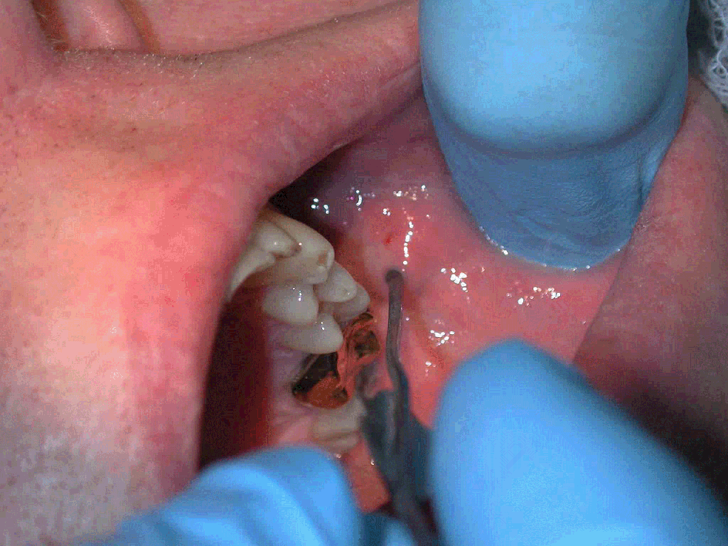 Sialogram Technique Iowa Head And Neck Protocols 