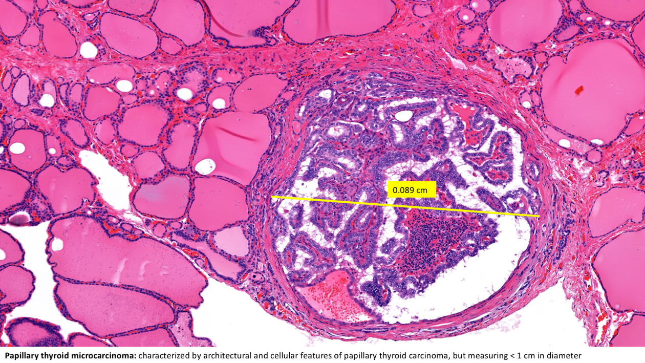 Variants of Papillary Thyroid Carcinoma (Microcarcinoma