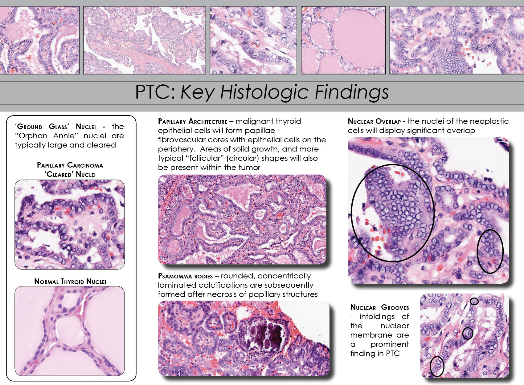 papillary carcinoma