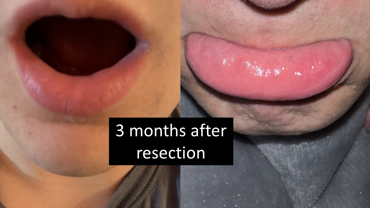 Lower Lip Bump Mucocele Verus Mucus Retention Cyst Minor Salivary 