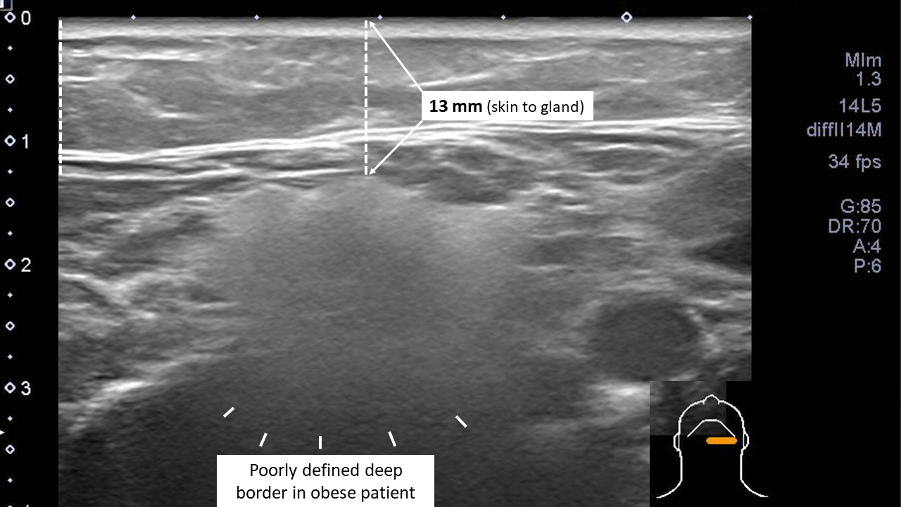 Submandibular Ultrasound - Altered Definition of Gland Margins Due to ...