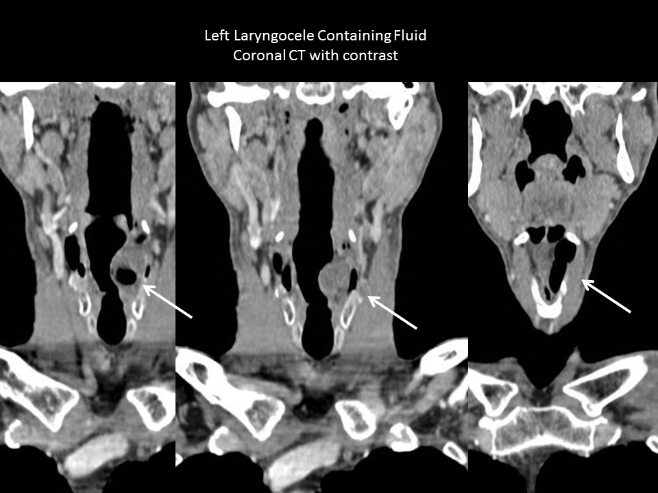 Laryngocele Saccular Cyst With Histopathology Laryngocoele Iowa