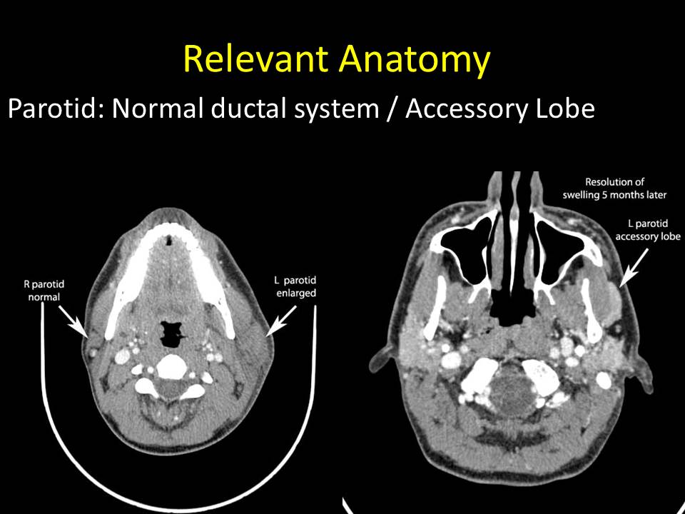 Relevant Anatomy for Sialendoscopy April 16 2015 Columbia Missouri