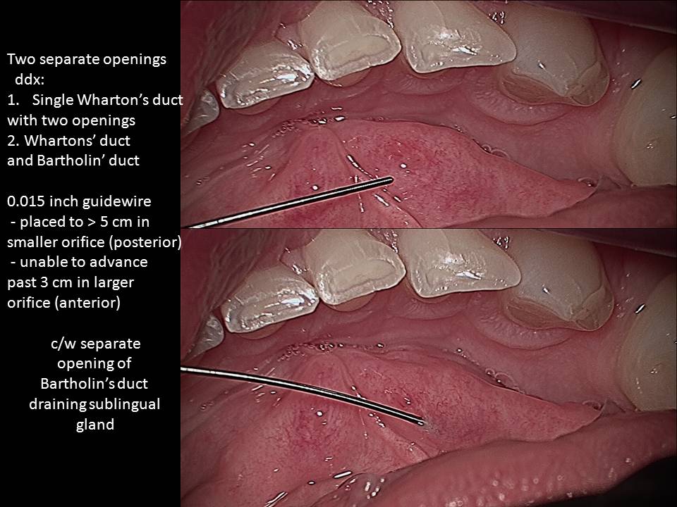 Bartholins duct anatomy | Iowa Head and Neck Protocols