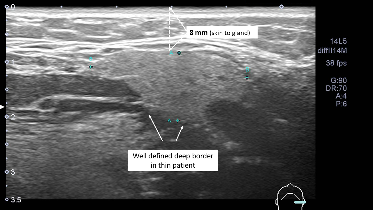 Submandibular Ultrasound - Altered Definition of Gland Margins Due to ...