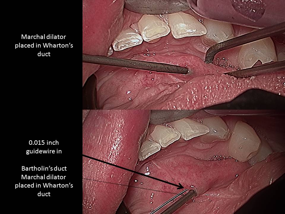 Bartholins duct anatomy | Iowa Head and Neck Protocols