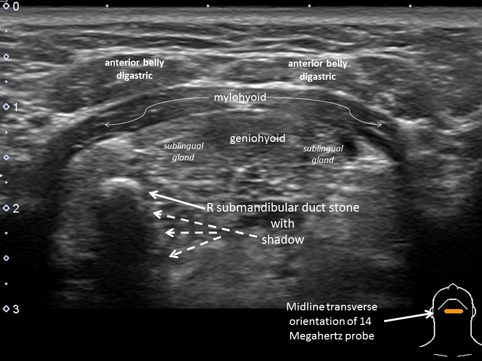 Salivary Ultrasound Sonopalpation for Stone Favorable for Transoral
