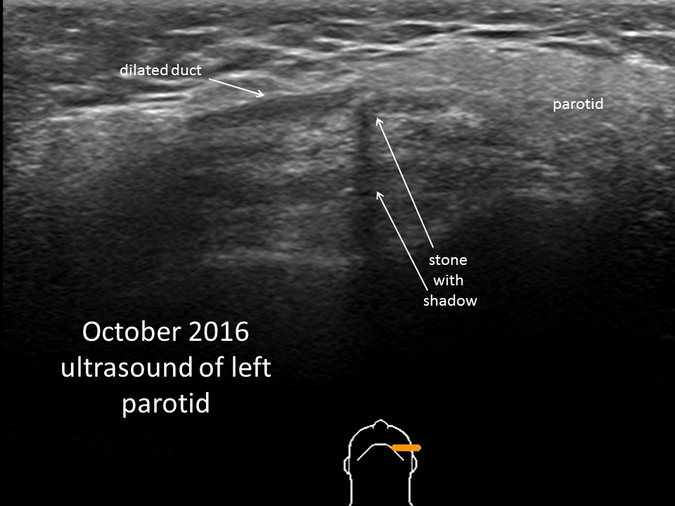 Parotid Gland On Ultrasound