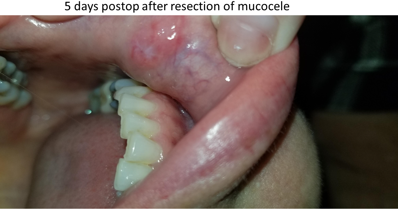 Complication From Lip Biopsy For Sjogrens With Mucocele Formation Granulation Tissue Iowa
