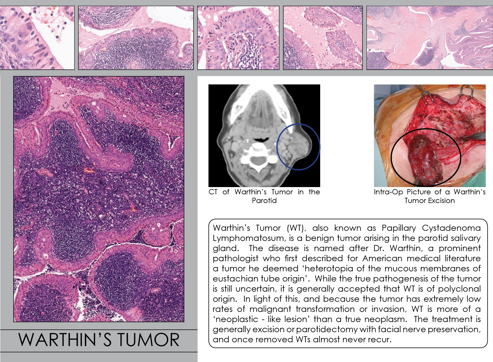 Warthin s Tumor Iowa Head And Neck Protocols