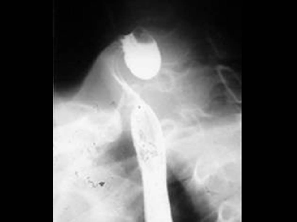 Hyoid bone - Wikipedia