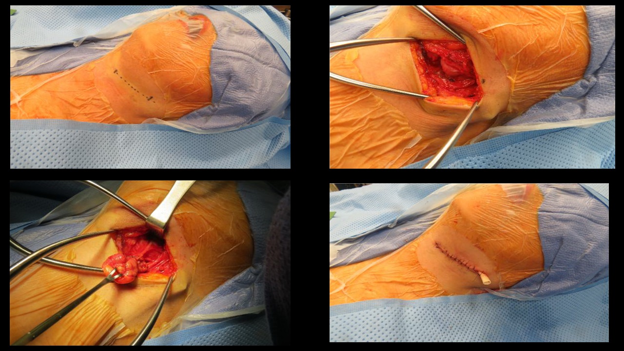 Chronic Submandibular Gland Sialadenitis: Case Example | Iowa Head and