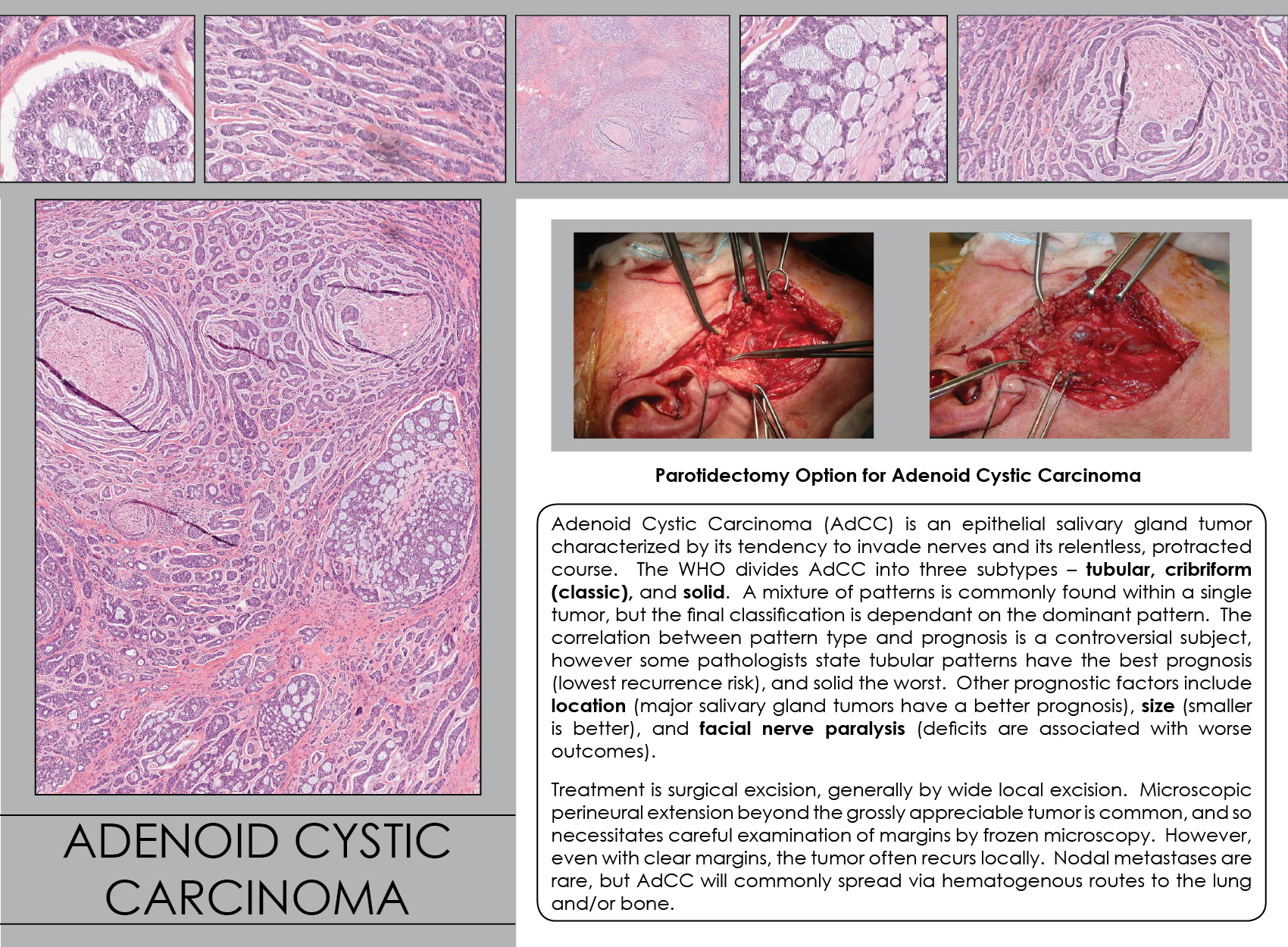 adenoid cystic carcinoma