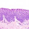 Moderate squamous dysplasia of right vocal cord