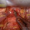 Subcarinal lymph nodes are resected under direct vision during esophagectomy