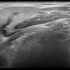 ultrasound and sialogram correlates of submandibular duct obstruction