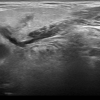ultrasound and sialogram correlates of submandibular duct obstruction