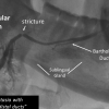 submandibular duct stricture with Bartholins duct present