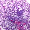 Lobule of minor salivary gland with lymphocytic-predominant foci of chronic inflammation