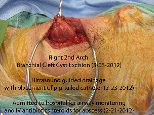 Arch Branchial Cleft Cyst Example